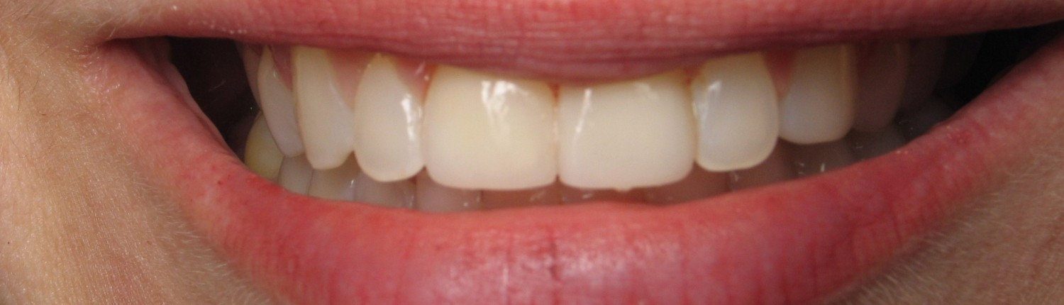 Smile After Veneers-Daniel N. Galaif, D.D.S.-Encino Dentist