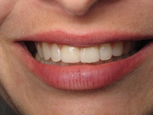 Smile After Veneers-Daniel N. Galaif, D.D.S.-Encino Dentist
