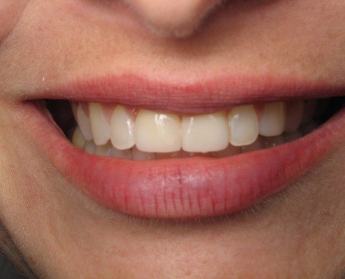 Smile After Veneers-Daniel N. Galaif, D.D.S.-Encino Dentist