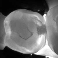 CaraVu Transillumination System-Daniel N. Galaif, D.D.S.-Encino Dentist