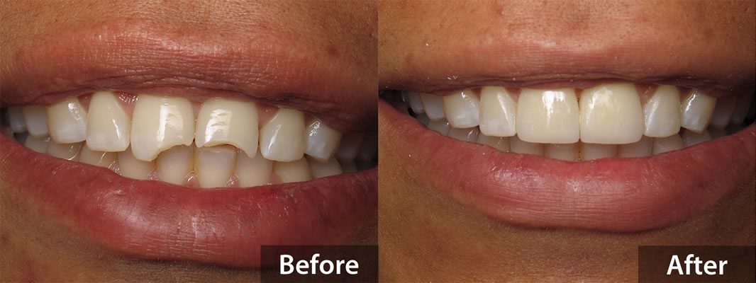 Dental Bonding - Before & After