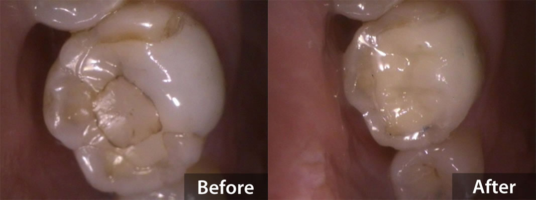 White Fillings - Before & After