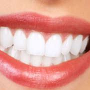 Smile after teeth whitening