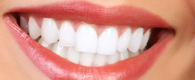 Smile after teeth whitening