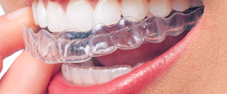Clear Braces to Optimize Your Smile!, Daniel N. Galaif, D.D.S., Encino  Dentist