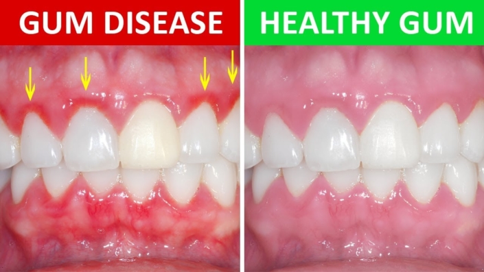 the-dangers-of-gum-disease-daniel-n-galaif-d-d-s-encino-dentist