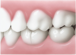 Craze Lines In Teeth - Pro Teeth Guard